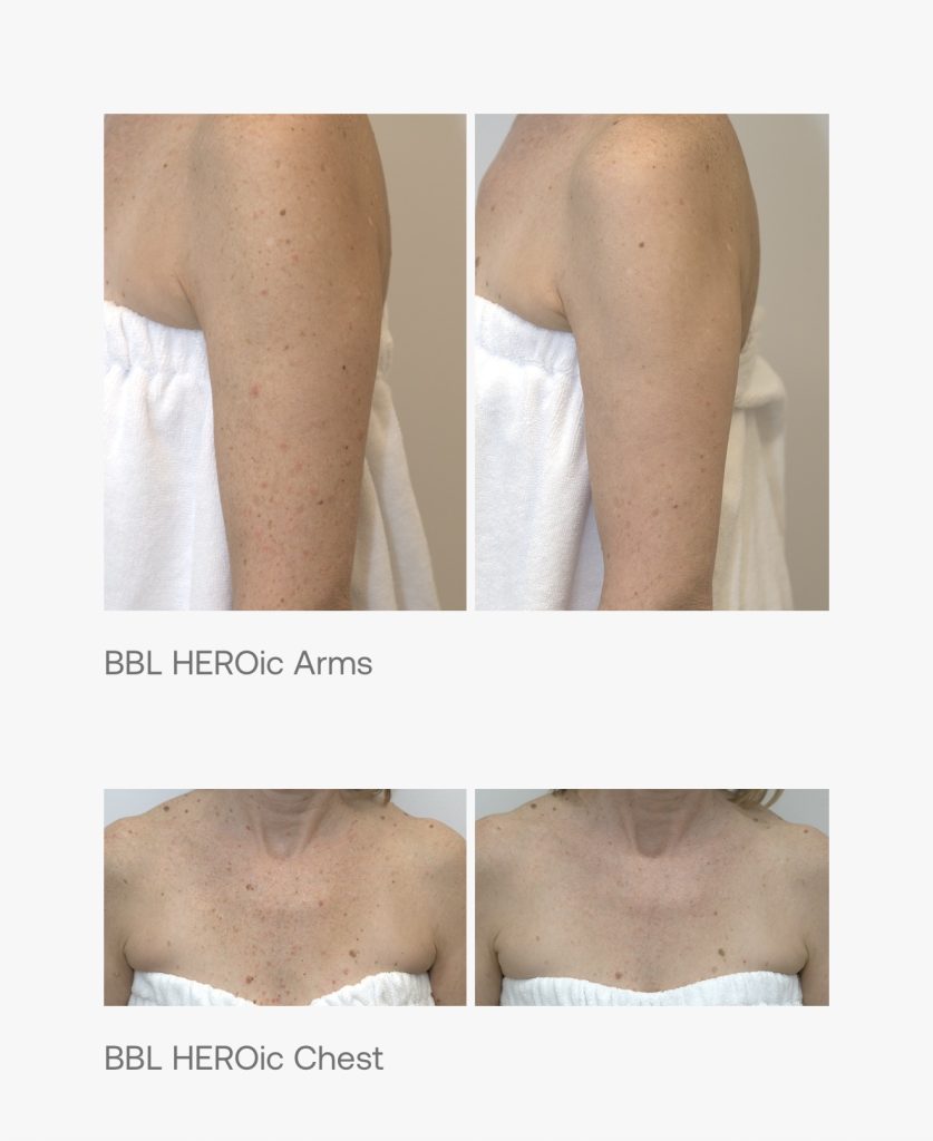 BBL HEROic arms and chest treatment in Yakima, WA