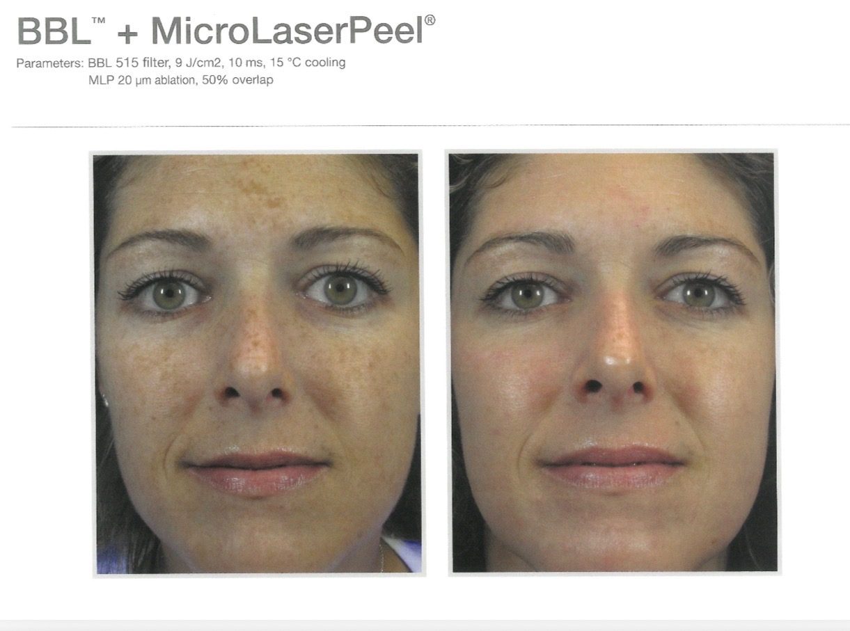 Before-and-after example for Sciton BBL and MicroLaserPeel facial rejuvenation