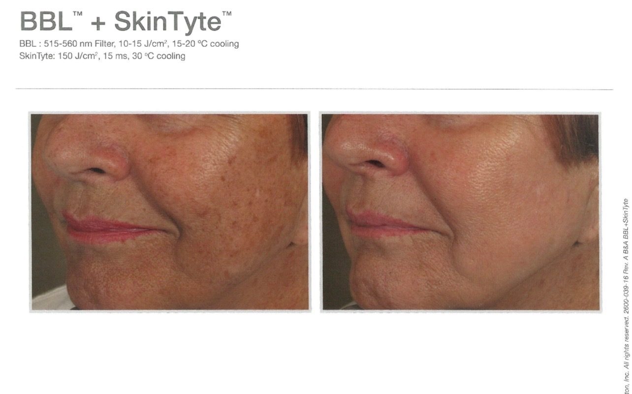 Before-and-after example for Sciton BBL and SkinTyte skin tone treatment