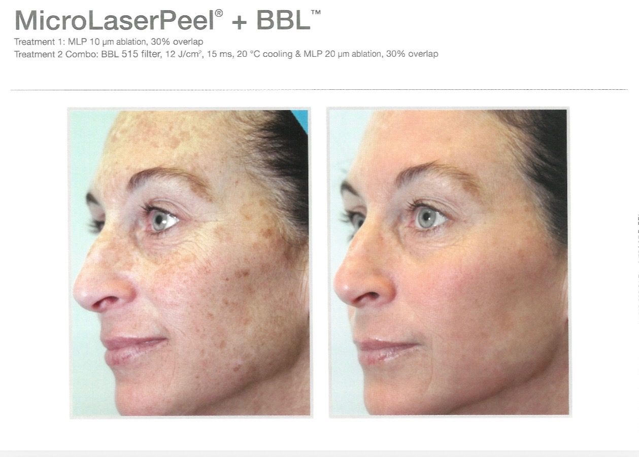 Before-and-after example for Sciton MicroLaserPeel and BBL treatment for pigmentation