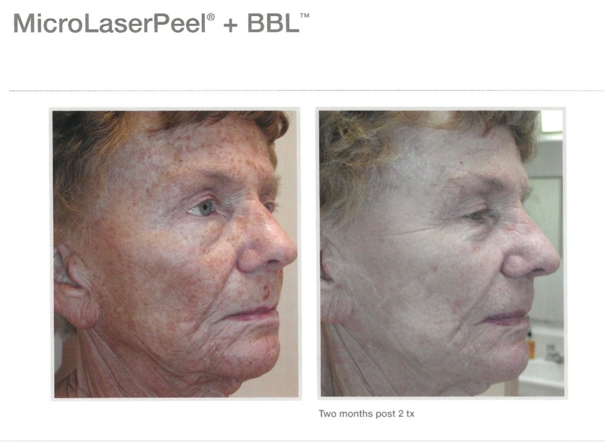 Before-and-after example for Sciton MicroLaserPeel and BBL treatment for sun damage
