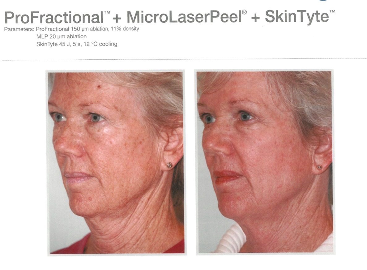 Before-and-after example for Sciton ProFractional, MicroLaserPeel, and SkinTyte facial rejuvenation