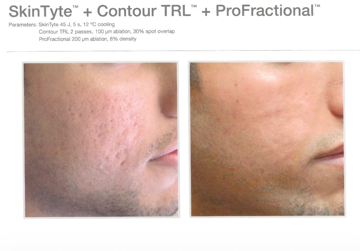 Before-and-after example for Sciton SkinTyte, Contour TRL, and ProFractional laser resurfacing